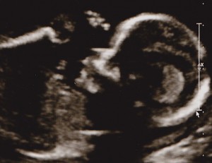 Baby Girl at 18 weeks, 5 days
